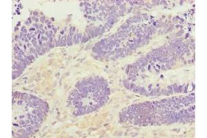 Immunohistochemistry of paraffin-embedded human ovarian cancer using ABIN7166396 at dilution of 1:100