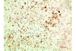 Immunohistochemical analysis of paraffin-embedded Human Ovarian Carcinoma Tissue using ATG5 Mouse mAb diluted at 1:200. (ATG5 antibody)