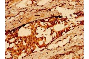 Immunohistochemistry of paraffin-embedded human breast cancer using ABIN7163584 at dilution of 1:100 (CD36 antibody  (AA 191-376))
