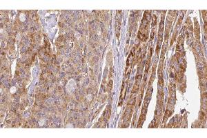 ABIN6267116 at 1/100 staining Human thyroid cancer tissue by IHC-P. (FLT3 antibody  (pTyr969))