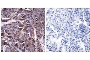 Immunohistochemical analysis of paraffin-embedded human breast carcinoma tissue using NFκB-p65 (Phospho-Thr505) Antibody (E011166). (NF-kB p65 antibody  (pThr505))