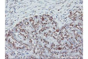 Immunohistochemical staining of paraffin-embedded Adenocarcinoma of Human ovary tissue using anti-GOLM1 mouse monoclonal antibody.