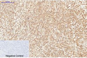 Immunohistochemical analysis of paraffin-embedded human breast cancer tissue. (XRCC4 antibody)