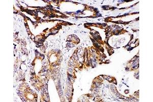 IHC-P: DCC antibody testing of human intestinal cancer tissue (DCC antibody  (AA 162-178))