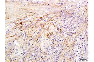 Formalin-fixed and paraffin embedded human colon carcinoma labeled with Anti-Hyaluronidase-1 Polyclonal Antibody, Unconjugated (ABIN673779) at 1:300 followed by conjugation to the secondary antibody and DAB staining (HYAL1 antibody  (AA 271-400))