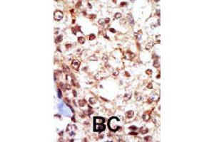 Formalin-fixed and paraffin-embedded human cancer tissue reacted with FGR polyclonal antibody  , which was peroxidase-conjugated to the secondary antibody, followed by AEC staining. (Fgr antibody  (N-Term))