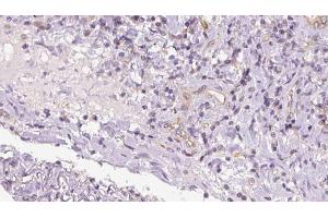 ABIN6273175 at 1/100 staining Human lymph cancer tissue by IHC-P.