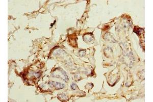 Immunohistochemistry of paraffin-embedded human breast cancer using ABIN7159277 at dilution of 1:100 (MAGEA9 antibody  (AA 1-315))
