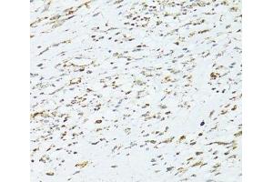 Immunohistochemistry of paraffin-embedded Human uterine cancer using TRIM15 Polyclonal Antibody at dilution of 1:100 (40x lens).