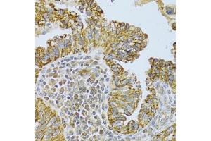 Immunohistochemistry of paraffin-embedded human endometrial cancer using DLD Antibody (ABIN5973132) at dilution of 1/100 (40x lens). (DLD antibody)