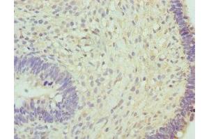 Immunohistochemistry of paraffin-embedded human ovarian cancer using ABIN7160269 at dilution of 1:100 (RNGTT antibody  (AA 1-260))