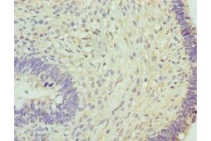 Immunohistochemistry of paraffin-embedded human ovarian cancer using ABIN7160269 at dilution of 1:100