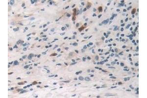 Detection of TNFa in Human Stomach cancer Tissue using Polyclonal Antibody to Tumor Necrosis Factor Alpha (TNFa) (TNF alpha antibody  (AA 77-233))