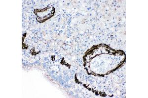 Anti-FABP6 antibody, IHC(P) IHC(P): Human Lung Cancer Tissue (FABP6 antibody  (N-Term))