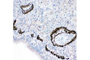 Anti-FABP6 antibody, IHC(P) IHC(P): Human Lung Cancer Tissue