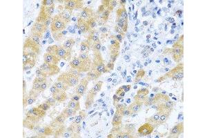 Immunohistochemistry of paraffin-embedded Human liver cancer using Gm13125 Polyclonal Antibody at dilution of 1:100 (40x lens).