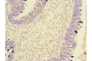 Immunohistochemistry of paraffin-embedded human ovarian cancer using ABIN7146760 at dilution of 1:100 (Carboxypeptidase A2 antibody  (AA 115-419))