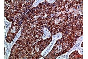 Immunohistochemical analysis of paraffin-embedded Human-lung-cancer, antibody was diluted at 1:100 (EPH Receptor B3 antibody  (AA 650-700))