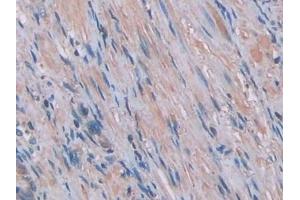 Detection of IL1a in Human Prostate Tissue using Monoclonal Antibody to Interleukin 1 Alpha (IL1a) (IL1A antibody  (AA 113-271))