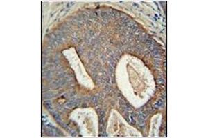 Immunohistochemistry analysis in formalin fixed and paraffin embedded human prostate carcinoma reacted with AP53394PU-N, which was peroxidase conjugated to the secondary antibody and DAB followed by staining. (POTEB antibody  (C-Term))