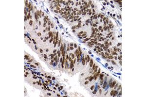 Immunohistochemistry of paraffin-embedded human colon cancer using MT2A antibody (ABIN1873764) at dilution of 1:200 (40x lens). (MT2A antibody)