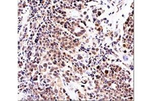 IHC testing of urinary transitional cell carcinoma stained with p21 antibody (WA-1). (p21 antibody)