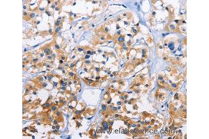 Immunohistochemistry of Human thyroid cancer using CAPZA3 Polyclonal Antibody at dilution of 1:70
