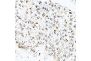 Immunohistochemistry of paraffin-embedded human lung cancer using CETN3 antibody at dilution of 1:100 (x40 lens).