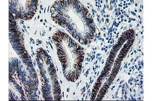 Immunohistochemical staining of paraffin-embedded Adenocarcinoma of Human endometrium tissue using anti-SOCS3 mouse monoclonal antibody. (SOCS3 antibody)