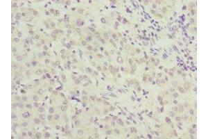Immunohistochemistry of paraffin-embedded human liver cancer using ABIN7167643 at dilution of 1:100 (RENT2/UPF2 antibody  (AA 1153-1272))
