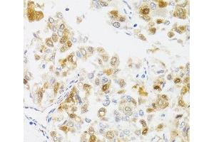 Immunohistochemistry of paraffin-embedded Human liver cancer using MYO5A Polyclonal Antibody at dilution of 1:100 (40x lens). (MYO5A antibody)