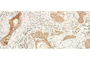 Immunohistochemistry of paraffin-embedded Human esophagus cancer tissue using MT-CO2 Polyclonal Antibody at dilution of 1:60(x200) (COX2 antibody)
