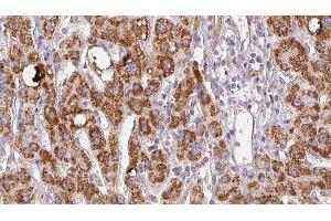 ABIN6278511 at 1/100 staining Human liver cancer tissue by IHC-P. (SLC26A5 antibody  (Internal Region))