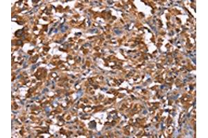 The image on the left is immunohistochemistry of paraffin-embedded Human thyroid cancer tissue using ABIN7191000(HRASLS2 Antibody) at dilution 1/40, on the right is treated with synthetic peptide. (HRASLS2 antibody)
