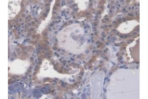 DAB staining on IHC-P; Samples: Human Thyroid cancer Tissue (Esophageal Cancer Related Gene 4 (AA 32-148) antibody)