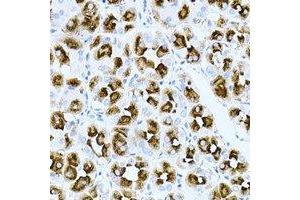 Immunohistochemical analysis of Rac 1 staining in human gastric cancer formalin fixed paraffin embedded tissue section. (RAC1 antibody)