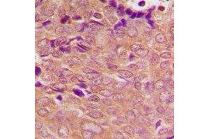 Immunohistochemical analysis of PSMC3 staining in human breast cancer formalin fixed paraffin embedded tissue section. (PSMC3 antibody)