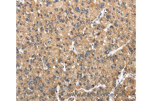 Immunohistochemistry of Human liver cancer using NDUFA5 Polyclonal Antibody at dilution of 1:40