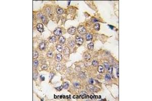 Formalin-fixed and paraffin-embedded human breast carcinoma tissue reacted with ERK2 antibody (C-term) (ABIN391720 and ABIN2841610) , which was peroxidase-conjugated to the secondary antibody, followed by DAB staining.