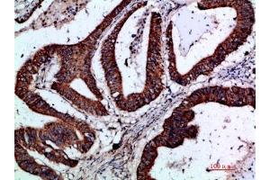 Immunohistochemical analysis of paraffin-embedded human-colon-cancer, antibody was diluted at 1:200.