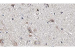 ABIN6272884 at 1/100 staining Human brain cancer tissue by IHC-P. (NDE1 antibody  (N-Term))