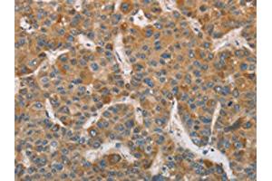 The image on the left is immunohistochemistry of paraffin-embedded Human liver cancer tissue using ABIN7129185(DDX53 Antibody) at dilution 1/75, on the right is treated with fusion protein. (DDX53 antibody)