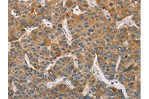 The image on the left is immunohistochemistry of paraffin-embedded Human liver cancer tissue using ABIN7129185(DDX53 Antibody) at dilution 1/75, on the right is treated with fusion protein.
