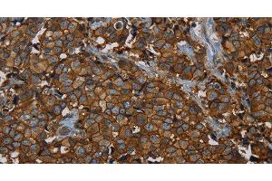 Immunohistochemistry of paraffin-embedded Human breast cancer using ERBB4 Polyclonal Antibody at dilution of 1:40 (ERBB4 antibody)