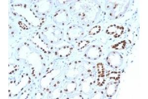 IHC testing of FFPE human renal cell carcinoma with PAX8 antibody (clone PAX8/1492). (PAX8 antibody  (AA 60-261))