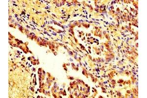 IHC image of ABIN7160125 diluted at 1:200 and staining in paraffin-embedded human lung cancer performed on a Leica BondTM system. (Moesin antibody  (AA 466-572))