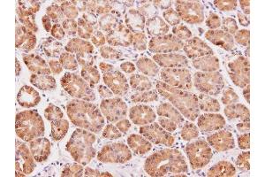 IHC-P Image Immunohistochemical analysis of paraffin-embedded human lung SCC, using DAK, antibody at 1:100 dilution.