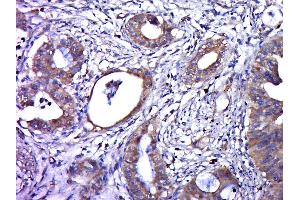Paraformaldehyde-fixed, paraffin embedded human cervical cancer, Antigen retrieval by boiling in sodium citrate buffer (pH6. (Human Papilloma Virus 16 E6 (HPV-16 E6) (AA 85-158) antibody)