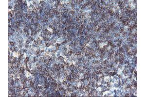 Immunohistochemical staining of paraffin-embedded Human lymphoma tissue using anti-DPH2 mouse monoclonal antibody. (DPH2 antibody)