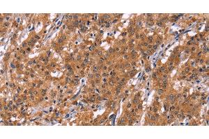 Immunohistochemistry of paraffin-embedded Human gastric cancer tissue using HLTF Polyclonal Antibody at dilution 1:30 (HLTF antibody)